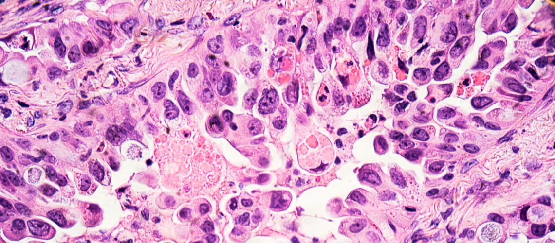 Cancer cells seen under microscope