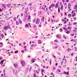 Cancer cells seen under a microsope