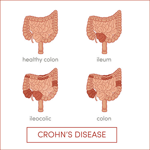 crohn's illustration