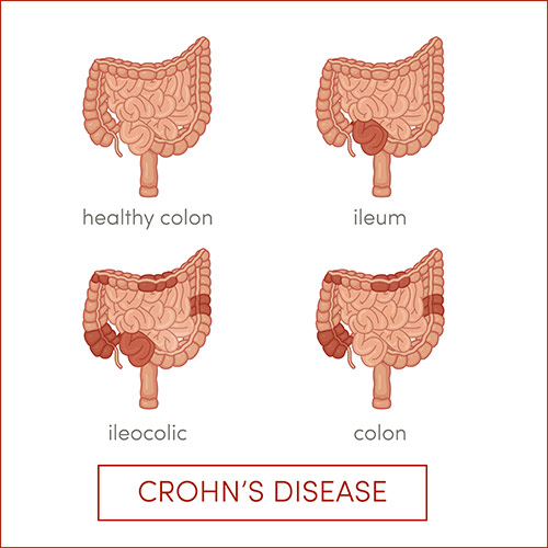 crohn's illustration